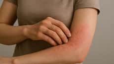 Illustration d'une plaque rouge causée par une allergie sur l'avant-bras. ©LP, Chat GPT 