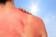 Un coup de soleil est une brûlure superficielle de la peau qui doit d’abord être refroidie. © juefraphoto, Fotolia