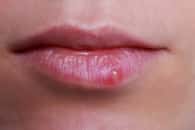 Un bouton d’herpès labial, aussi appelé bouton de fièvre. © deviddo, Adobe Stock