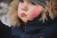 L'urticaire au froid peut aussi toucher les enfants. © illustrissima, Adobe stock