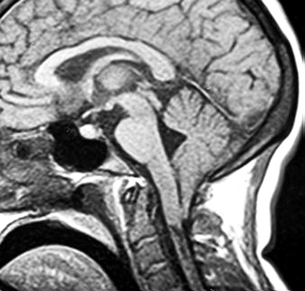 Le syndrome d’Arnold-Chiari est une malformation rare du cervelet. © Journal of Neurology, Neurosurgery, and Psychiatry