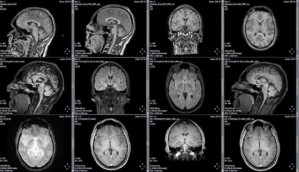 IRM d'un cerveau. © Delphotostock, Adobe Stock&nbsp;