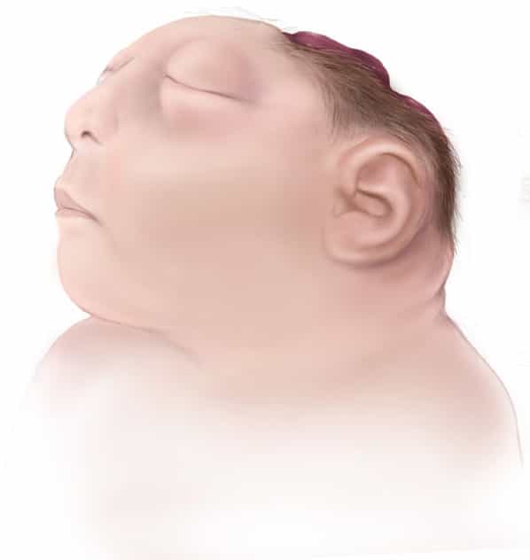 La plupart des enfants qui naissent avec une anencéphalie sont mort-nés. © www.cdc.gov