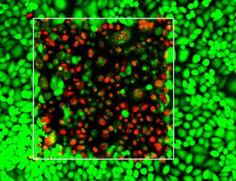 Sur cette image en fausses couleurs prises avec un microscope, les cellules cancéreuses vivantes (en vert) entourent des cellules cancéreuses mortes (en rouge) à la suite de l'irradiation au laser dans le carré blanc. C’est une illustration de l'efficacité de la thérapie photodynamique. © Université de Buffalo, 2014
