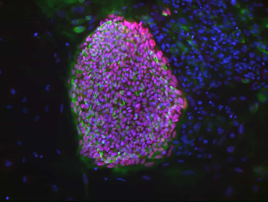 Cette colonie de cellules souches embryonnaires (les marqueurs verts et rouges marquant la pluripotence) a été obtenue par clonage thérapeutique à partir de cellules somatiques issues d’une patiente souffrant de diabète de type 1. Plus tard, les scientifiques ont réussi à différencier ces cellules souches en cellules bêta-pancréatiques, faisant défaut dans cette maladie. © Bjarki Johannesson, NYSCF