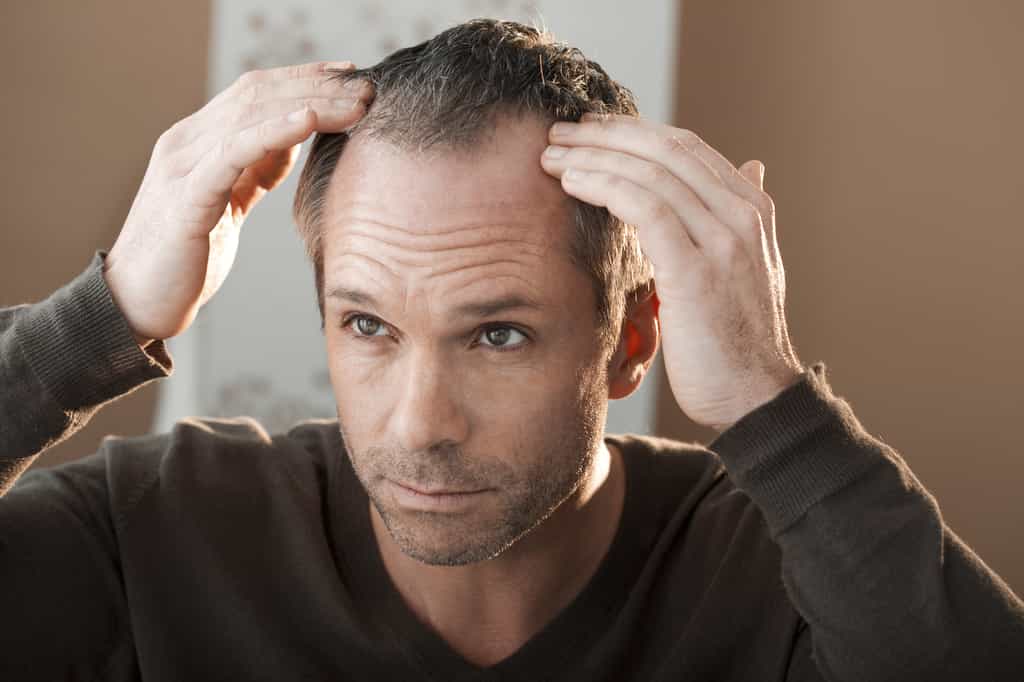 Les hommes sont plus touchés par l'alopécie androgénétique héréditaire (la calvitie) que les femmes. © RFBSIP, Adobe Stock