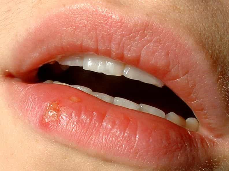 Le virus de l’herpès provoque les boutons de fièvre. © Metju12, Wikimedia Commons, DP