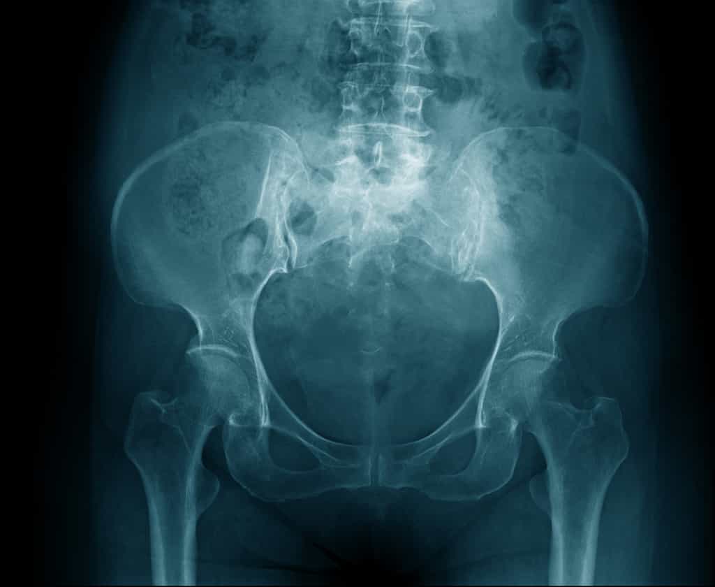 Plus d’un quart des hommes adultes ont une densité minérale osseuse insuffisante. © Angkhan, Fotolia