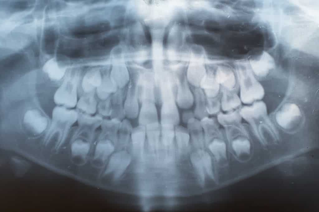 L’odontome est une tumeur bénigne très rare. © alex_tsarik - Fotolia