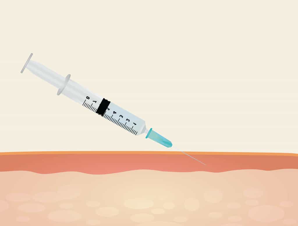 La plupart des vaccins sont administrés par voie&nbsp;intramusculaire. À l’heure actuelle, seul le vaccin BCG est administré par voie intradermique. © marijaobradovic, Adobe Stock