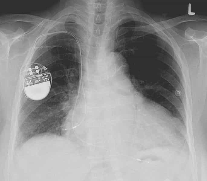 Aujourd'hui, certains patients avec de graves troubles cardiaques se voient opérés et équipés d'un pacemaker, comme on le voit à l'image. Même si l'outil prolonge la vie, il n'est pas sans contrainte, car il faut changer les piles tous les 5 à 7 ans en moyenne, ce qui implique de la chirurgie lourde et régulière. Cette nouvelle technique de pacemaker biologique, si elle montre son efficacité et sa durabilité, pourrait nécessiter un seul et unique traitement. © Lucien Monfils, Wikipédia, cc by sa 3.0