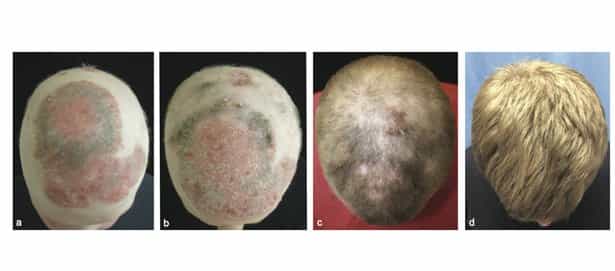 Ce patient totalement glabre (image de gauche) a bénéficié d'un tout nouveau traitement qui a conduit à la repousse des cheveux. Les images suivantes montrent sa tête après deux, cinq et huit mois de traitement. © Yales