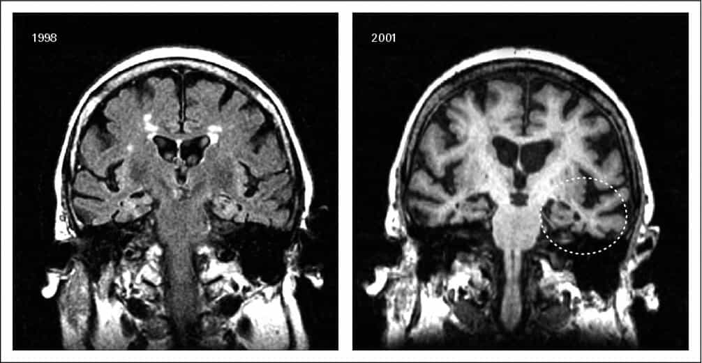  Un cliché pris par imagerie par résonance magnétique (IRM) d'un patient atteint de la maladie d'Alzheimer qui montre clairement une très nette atrophie du cerveau entre 1998 et 2001. © DR