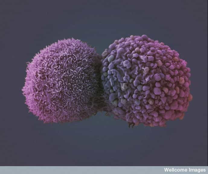 Le cancer a été diagnostiqué en France pour plus de 350.000 personnes en 2010 et a fait près de 150.000 victimes. Le cancer du poumon, dont on voit des cellules tumorales, est le plus meurtrier (responsable de 21.000 morts). © Wellcome Images, Flickr, cc by nc nd 2.0