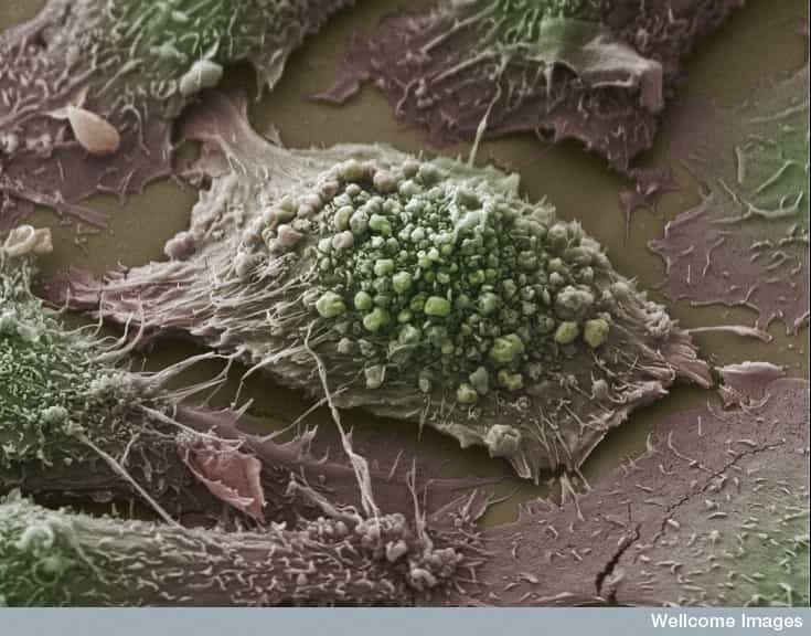Les tumeurs solides deviennent plus dangereuses à partir du moment où les cellules malades se disséminent et s'en prennent à un autre organe. Une fois le cancer à ce stade, il devient difficile de le traiter. Mais peut-être qu'un petit virus pourrait tout changer... © Anne Weston, Wellcome Images, Flickr, cc by nc nd 2.0