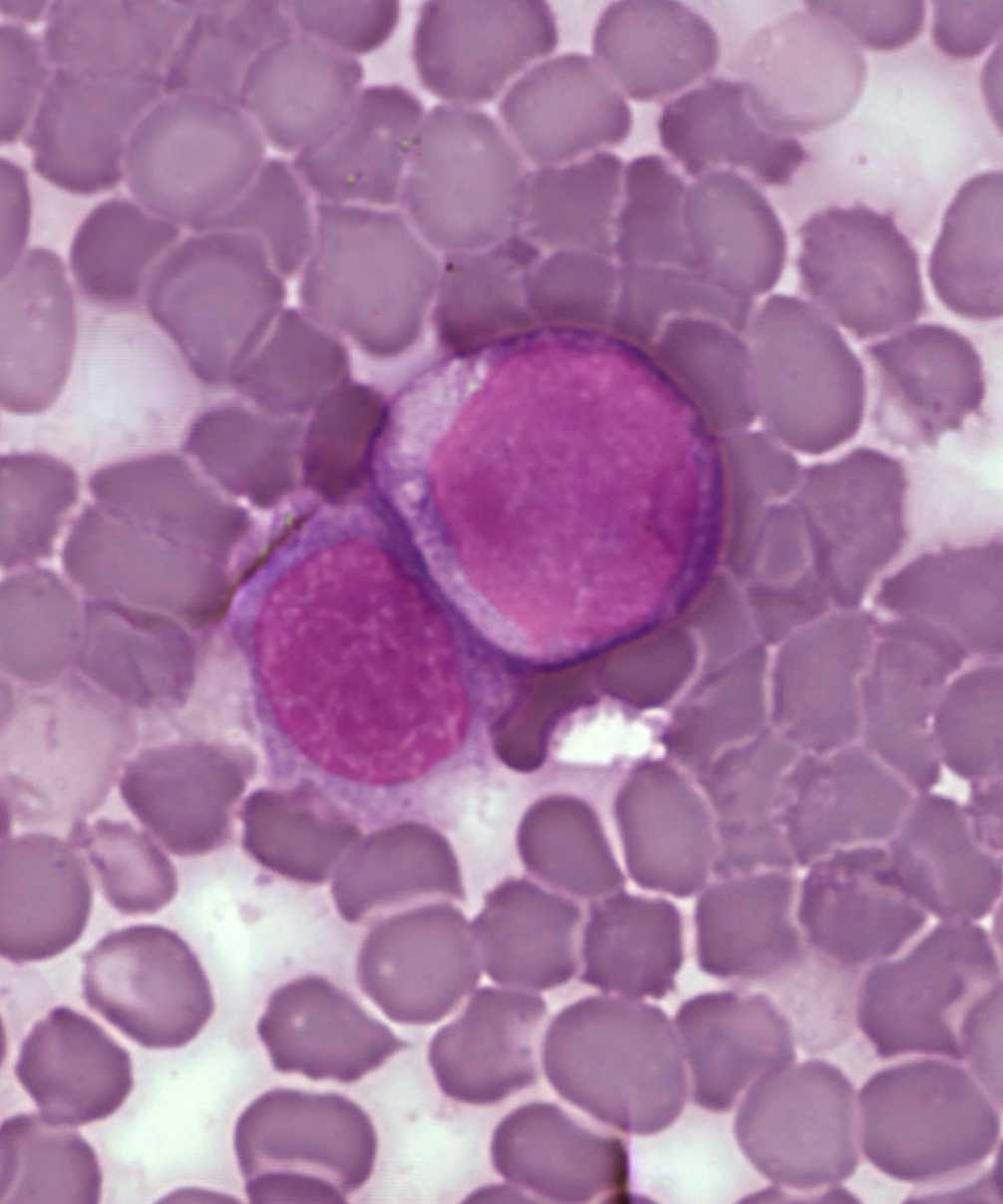 Lors d'une leucémie, les cellules de la moelle osseuse deviennent cancéreuses. Si elles prolifèrent, c'est souvent parce que le système immunitaire ne dispose pas des lymphocytes T CD8 capables d'en débarrasser l'organisme. © Plos One, cc by 2.5