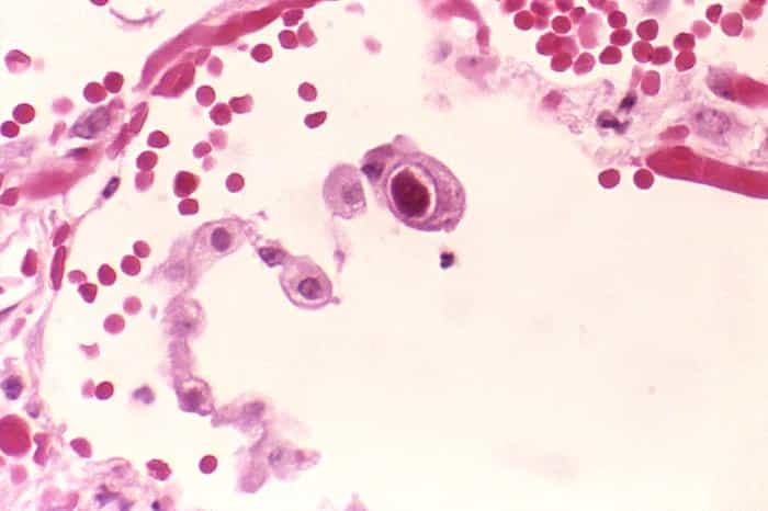 Le cytomégalovirus est le plus souvent bénin, mais peut se révéler agressif chez des patients immunodéprimés, comme les personnes infectées par le VIH. Et il pourrait également faciliter l'apparition du diabète ! © Edwin P. Ewing, CDC, DP