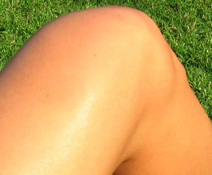 Un nouveau ligament du genou pourrait expliquer pourquoi les sportifs ayant subi une rupture du ligament croisé antérieur ont parfois du mal à récupérer toute la mobilité de leur articulation.&nbsp;© ArnoldReinhold, Wikipédia, cc by sa 3.0
