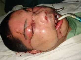 Le visage du patient chinois après l'opération(Courtesy of AP)