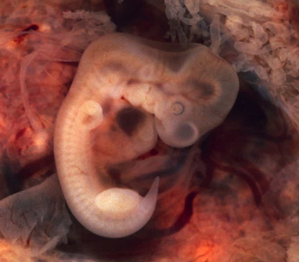 Embryon de dix millimètres issu d'une grossesse ectopique. Dans de nombreux cas, la grossesse extra-utérine peut nécessiter une prise en charge hospitalière d’urgence. © Ed Uthman, Wikipédia, DP