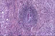 Crédits : INSERM 2001.Hépatite chronique virale C. Nodule lymphoïde intra portal, au sein duquel le canal biliaire présente des lésions dégénérative. Il existe aussi des lésions de nécroses pacellaires. HES, grandissement