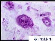 Neurones embryonnaires greffés dans le thalamus d'un rat adulte depuis deux mois. Coloration au violet de crésyl. Parkinson.Crédits : INSERM 89