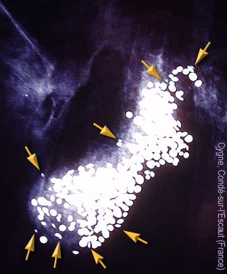 Cette radiographie d'un cygne trouvé mort à Condé-sur-l'Escaut (Nord) met en évidence un grand nombre de grenailles de plomb, provenant de cartouche de chasse et ingérées avec les gastrolithes. Les flèches jaunes montrent des grains de plomb déjà très érodées. L'animal a dû mourir en quelques jours d'une intoxication aiguë. © Lamiot, Wikipédia, GNU 1.2