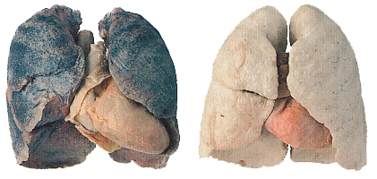 A gauche des poumons de fumeur (la couleur noire provient des goudrons). A droite des poumons sains.