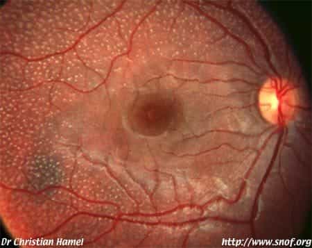 Dans neuf cas sur dix, la rétinopathie pigmentaire affecte les bâtonnets, photorécepteurs servant à la vision crépusculaire, première affectée par la maladie. Les cellules touchées, de plus en plus nombreuses, deviennent colorées et insensibles à la lumiè