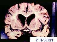 Maladie d'alzheimer. Coupe de cerveau humain, atrophie corticale et dilatation ventriculaire.Crédits : INSERM