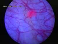Cancer de la vessie détecté par fluorescence