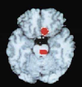 Les taches rouges montrées par cette tomographie par émission de positrons (TEP) indiquent une augmentation du débit sanguin provoquée par une crise de migraine.