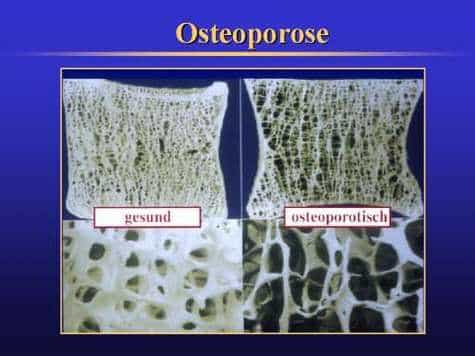 Différence entre des os sains et des os atteint d' ostéoropose