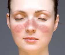 Le lupus est une maladie auto-immune qui provoque l'apparition d'un érythème facial en forme de papillon. © NIH, Wikimedia, domaine public