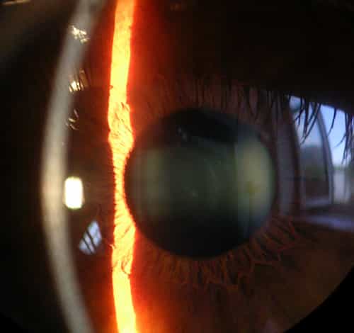 L'œil est l'objet de soins depuis plusieurs millénaires. Les techniques modernes d'ophtalmologie permettent peu à peu de rendre la vue à des personnes aveugles.&nbsp;© Baristoprak, Wikipédia, DP