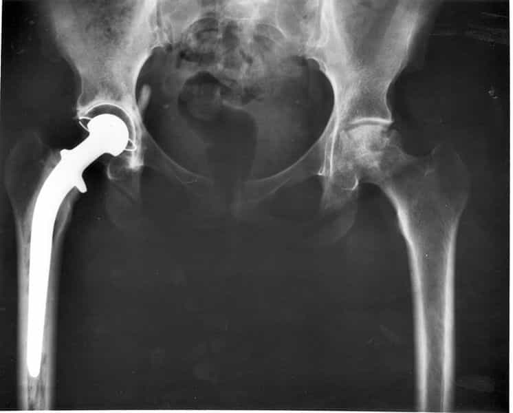 Les prothèses de hanche de l'entreprise Ceraver ont été rattrapées par l'ANSM. Des modifications ne bénéficiant pas d’un marquage CE ont été installées de manière non conforme.&nbsp;© NIH, Wikipédia, DP
