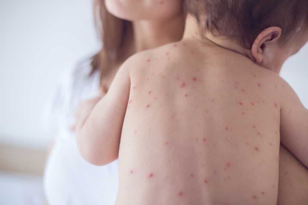 La rougeole est une maladie virale parmi les plus contagieuses qui touchent les enfants. © South_agency, Istock.com