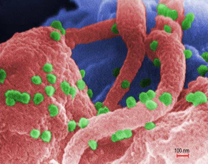 Les particules de VIH, qui apparaissent ici en vert sous microscopie à balayage électronique, s'attaquent aux lymphocytes T4, des cellules fondamentales du système immunitaire. À terme, ce sont toutes les cellules immunitaires qui en pâtissent, le patient déclenche alors le Sida et devient sensible à toute infection. © C. Goldsmith, Wikipédia, DP