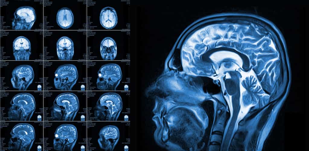 Des microélectrodes ont été implantées dans le cerveau du patient. © Maxim Pavlov, Fotolia