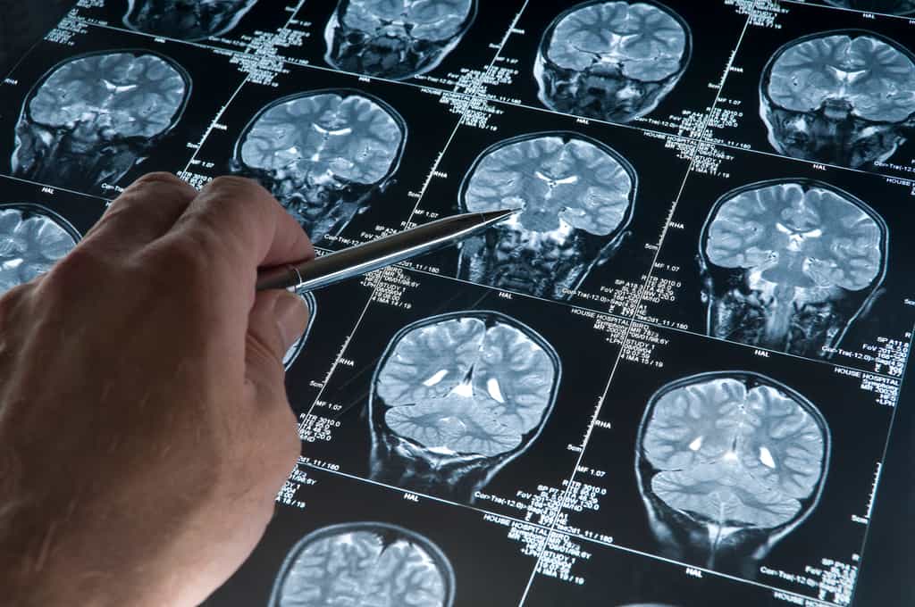 L'accumulation d'une protéine, l'alpha-synucléine, dans le cerveau est bien liée à certaines formes de la maladie de Parkinson, confirme une étude. © haydenbird, Getty Images
