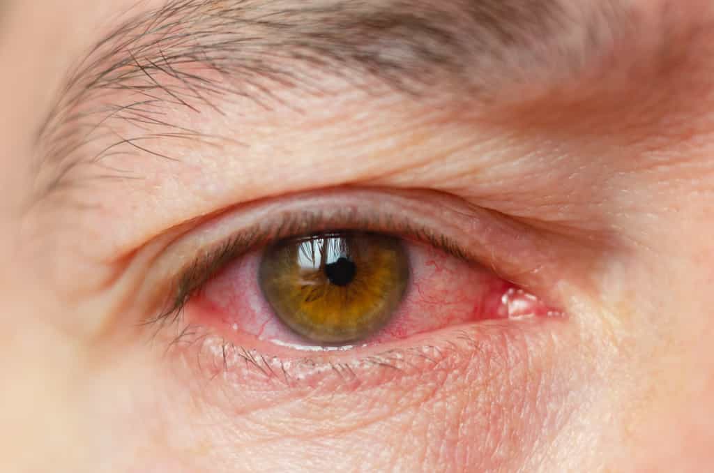 L'œil peut être le théâtre d'infections inhabituelles. © andrei310, Adobe Stock