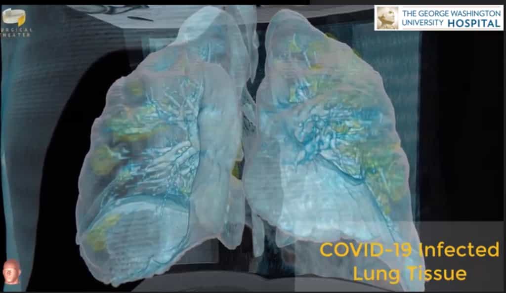 Pas besoin d'être un médecin pour visualiser les dégâts sur les poumons d'un malade du Covid-19 grâce à la VR. © George Washington University Hospital