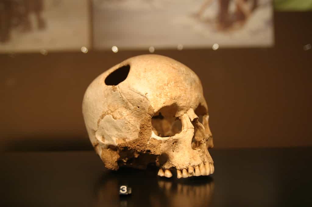 Ce crâne porte les traces d’une trépanation. La fillette ainsi opérée il y a 5.500 ans a survécu à la chirurgie. © Rama, Wikipédia, cc by sa 2.0