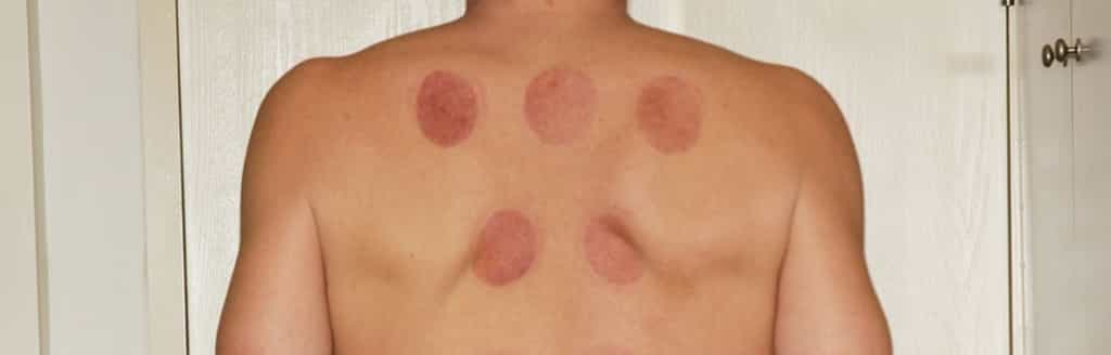 Une séance de cupping peut laisser ces étranges traces non douloureuses, même si elle présente tout de même un danger de lésions cutanées. © pxhere