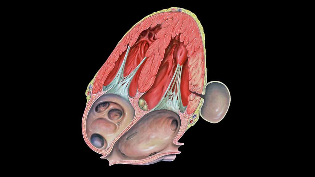Pseudo-anévrisme du ventricule gauche