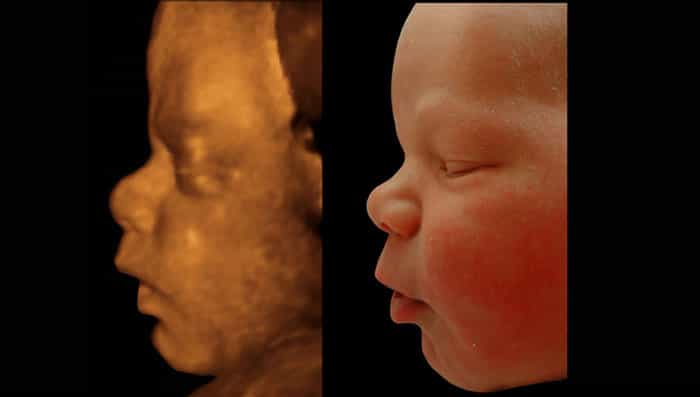 Visage du fœtus et du nouveau-né de profil