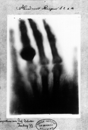 1895 : découverte des rayons X par Röntgen et début de la radiographie