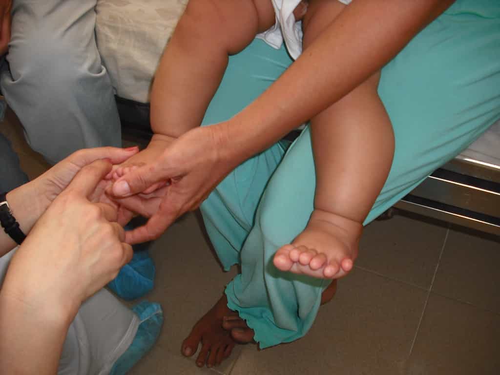 Exemple d'une polydactylie postaxiale au niveau du pied. L’ablation des doigts surnuméraires peut être réalisée à partir de l’âge de six mois. © ReSurge International, Flickr, CC by-nc-nd 2.0