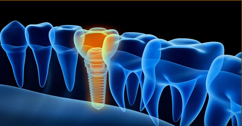 Chirurgie dentaire : la pose d'implant dentaire