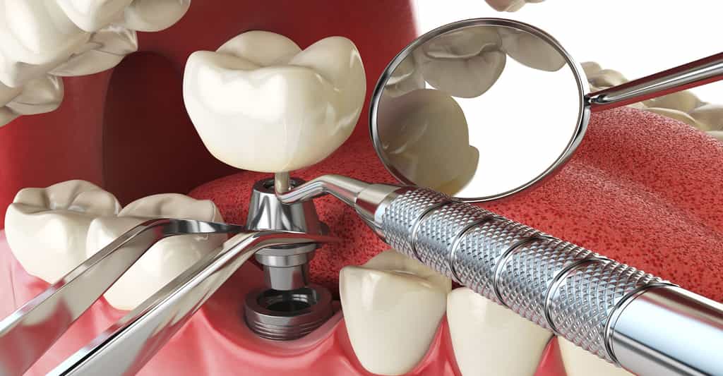 Implant dentaire : avantages et contre-indications